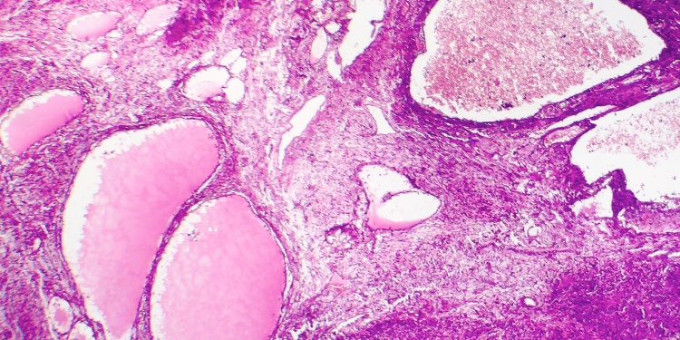 Batteri buoni per divorare il DNA dei tumori la scoperta