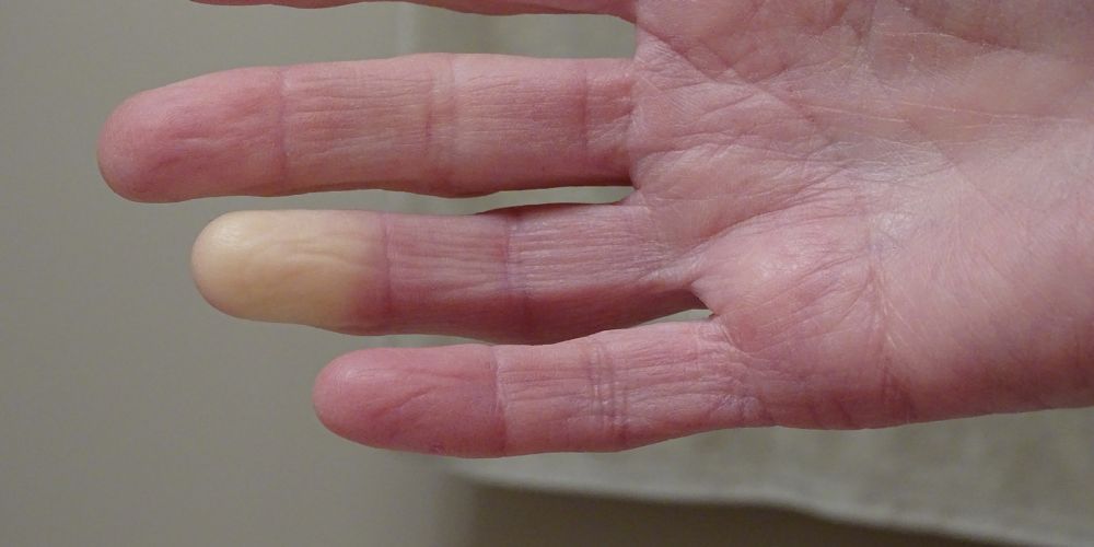 Scoperti due geni che influiscono sul fenomeno di Raynaud