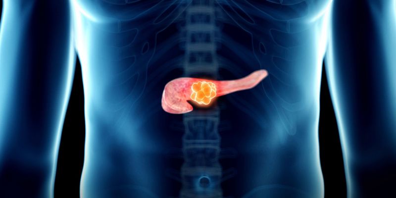 Lotta contro il tumore al pancreas individuato uno dei ‘nemici’