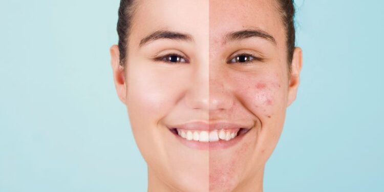 Batteri smart anti-acne, nuova speranza per la cura delle pelle
