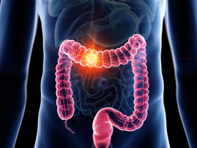 Cancro del colon-retto