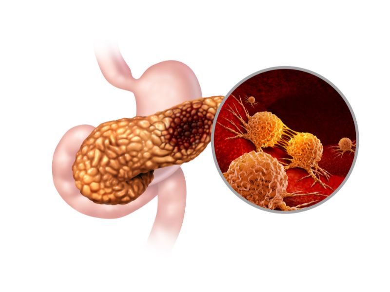 Tumore del pancreas cure