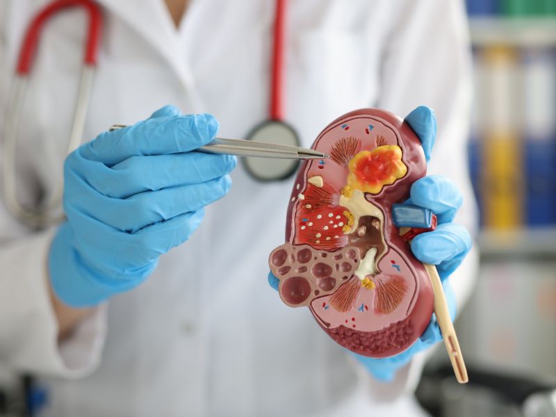 Malattia renale cronica: un italiano su 8 è a rischio