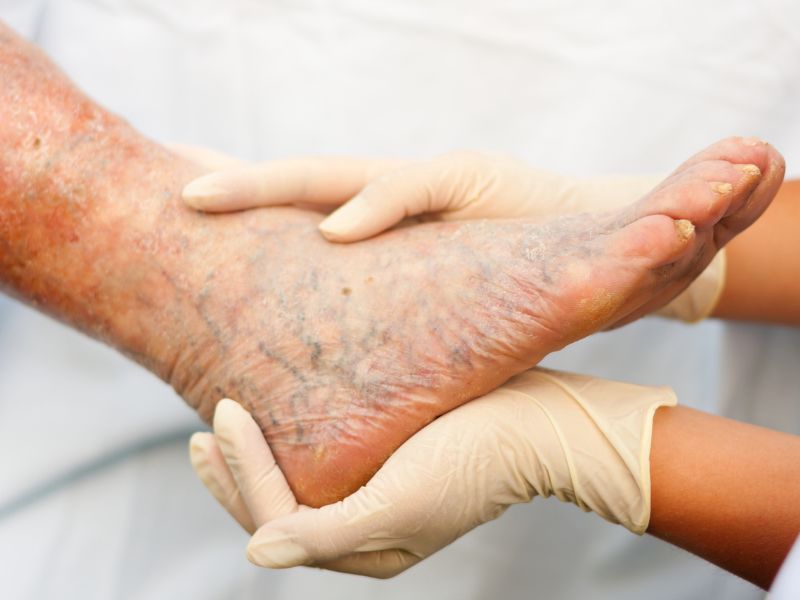Insufficienza venosa, dopo i 50 anni ne soffre 1 donna su 2