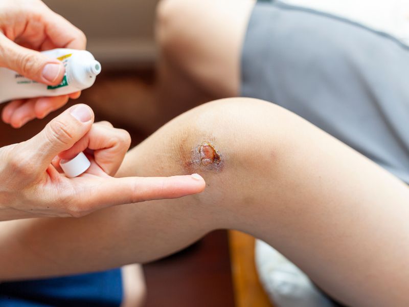 In Italia si utilizzano troppo le creme antibiotiche