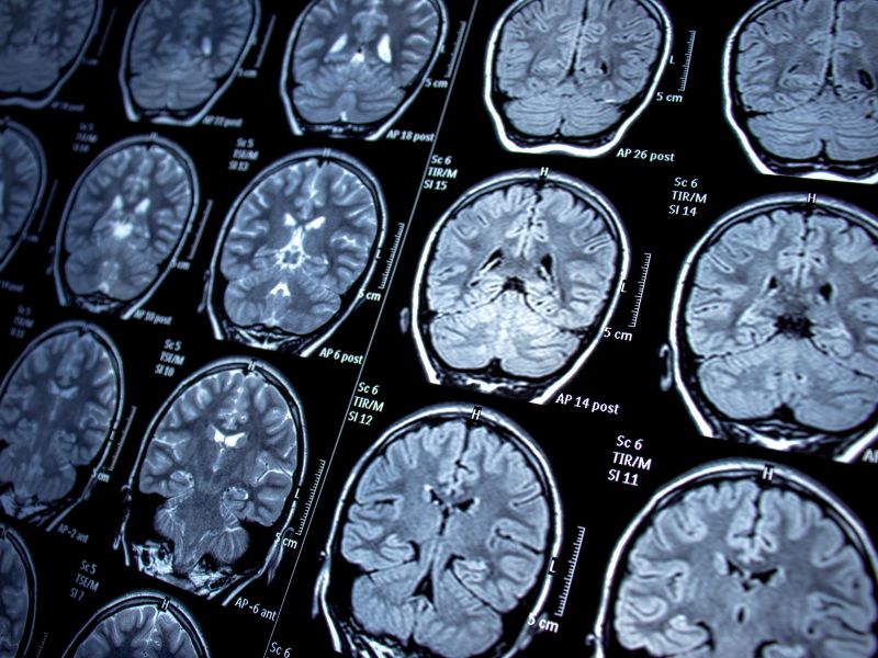 Le malattie neurologiche sono sempre in agguato: attenzione ai sintomi da non sottovalutare