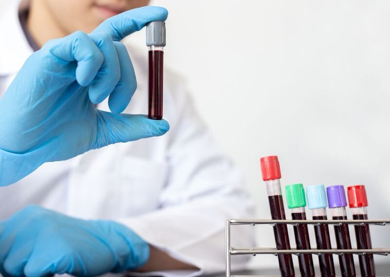 Un test del sangue per prevedere il rischio di ictus