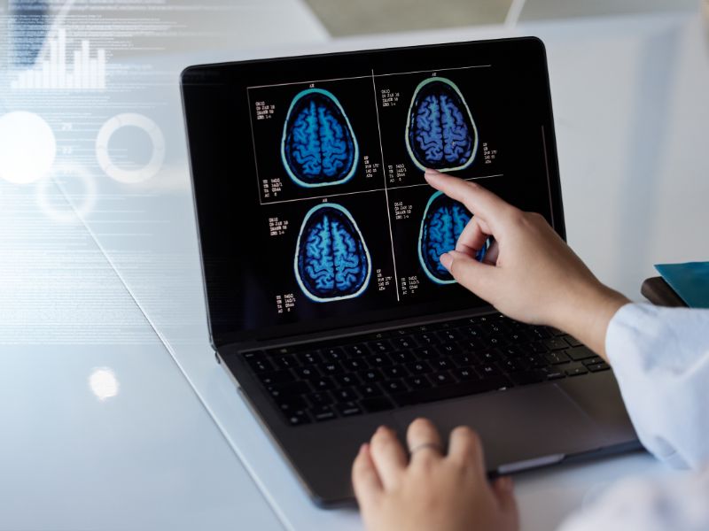 Gliobastoma, nuove speranze dal progetto Gliomatch