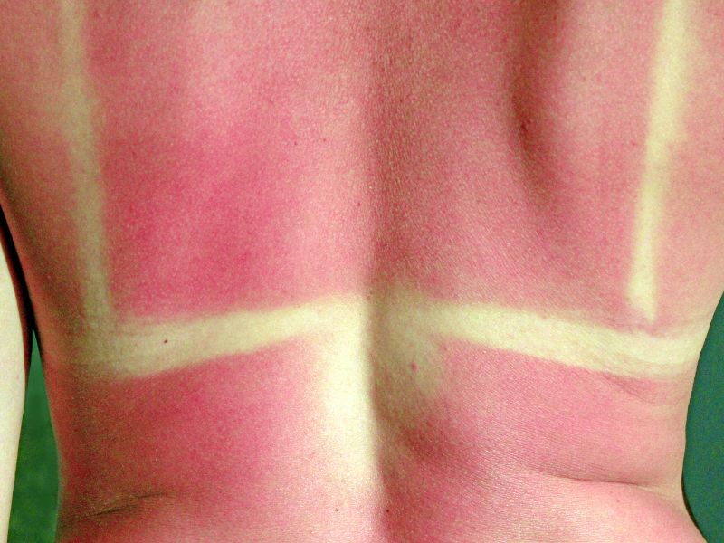 Attenzione alle scottature: i punti del nostro corpo più sensibili