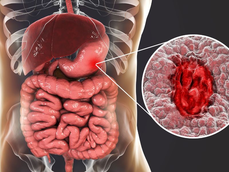 “Lo stress fa venire l’ulcera”, ma sarà vero? Risponde la scienza
