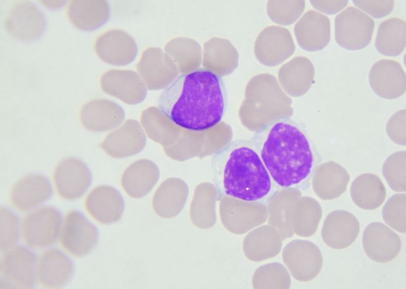 Tumori del sangue