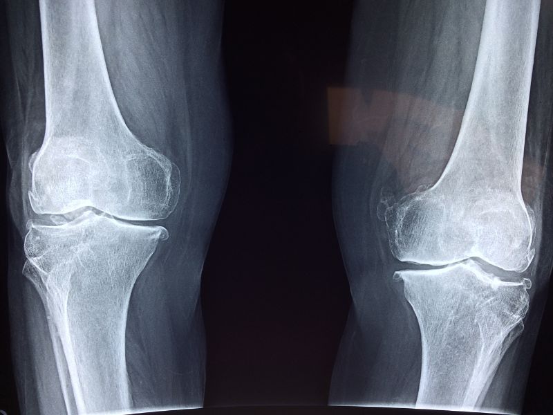 Osteoporosi: la subdola malattia delle ossa